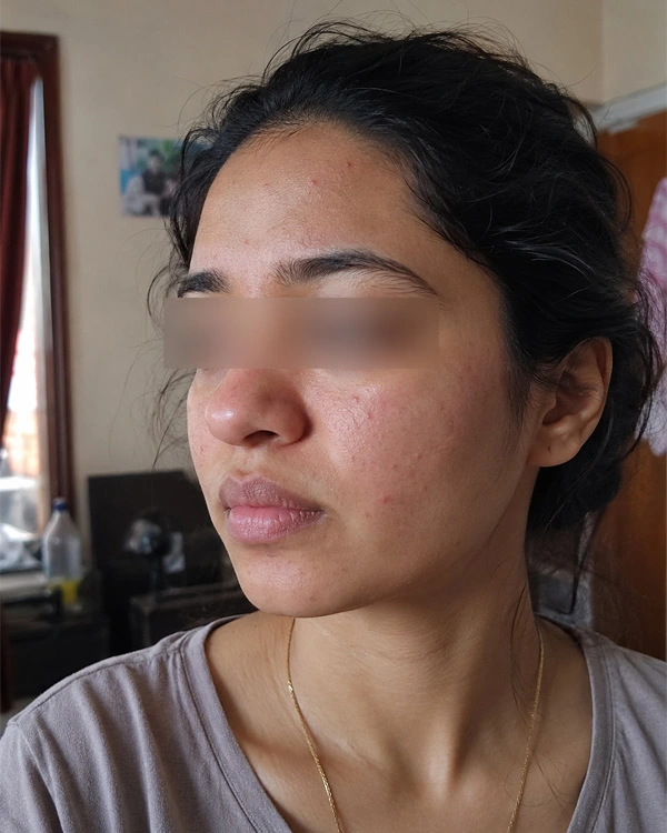 Allergy relief care before result